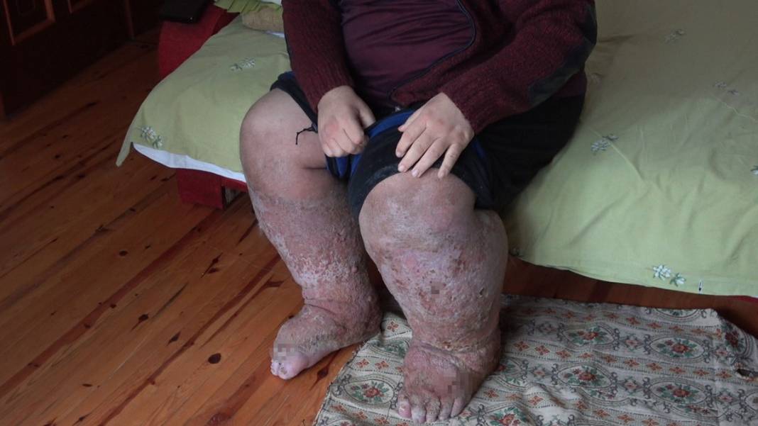 Sivrisinek, hayatının kabusu oldu! Öyle bir hastalığa yakalandı ki doktorlar çaresiz kaldı 4